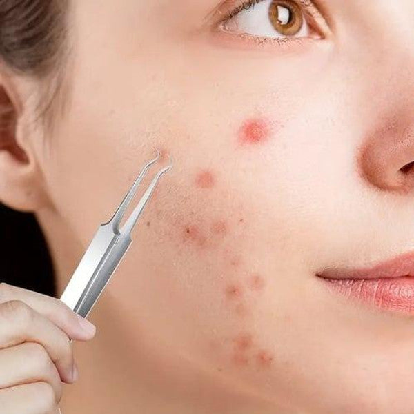 Stainless Steel Blackhead Remover with Precision Tips